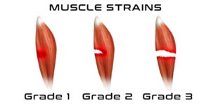 Grades of muscle strains