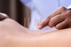 what is acupuncture