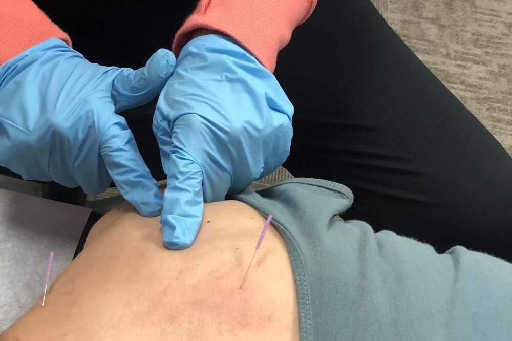 Chiropractic Dry Needling in Kansas City